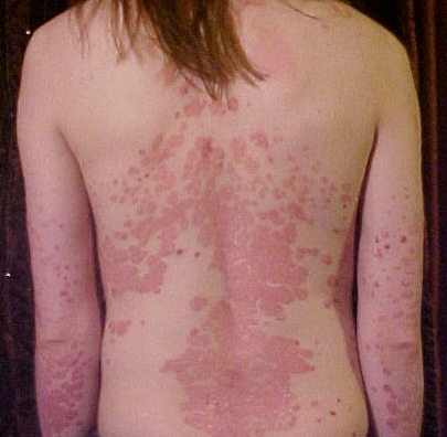 Psoriasis on back1